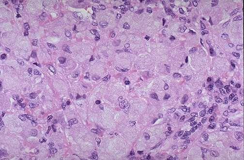 Splenomegalia