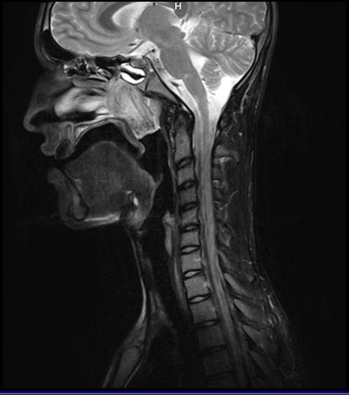 jellemző, ujjal történő iatrogen mechanikus trauma. Orr piszkálásának hatására sérül a mucosa és a bőr határán a nyálkahártya, és gyakran orrvérzés alakul ki.