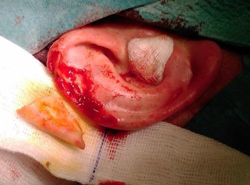 ). Vulnus ruptum, -