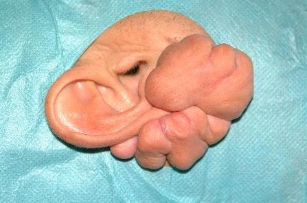 24) Keloid