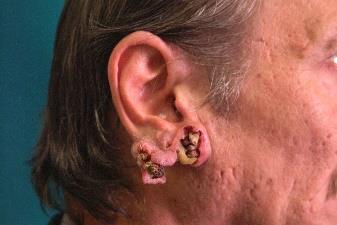 Rosszindulatú daganatok Planocellularis carcinoma (Ábra 1.