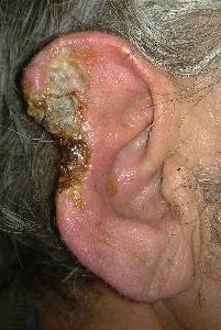 28) Melanoma malignum Hallójárat (meatus acusticus externus) normál