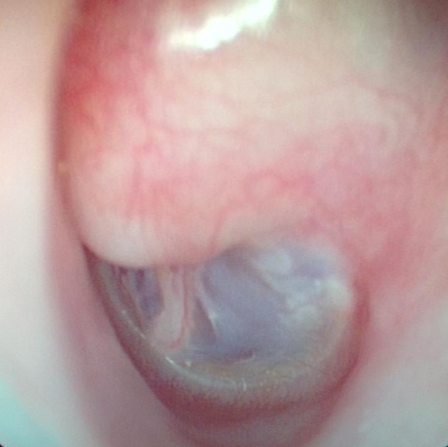 folliculitis, furunculus (otitis