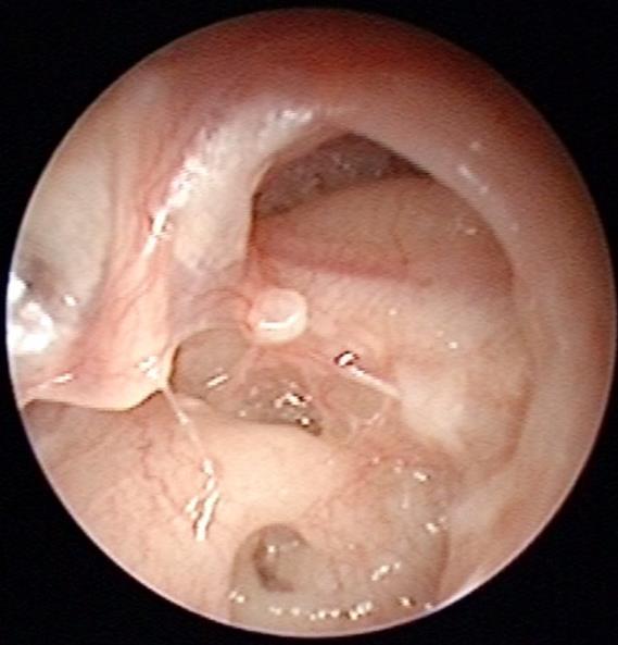 mesotympanalis): centrális perforáció (Ábra 1.43.) Cholesteatomás (Ot. med. supp. chr.