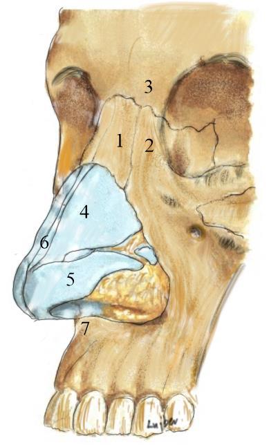 Flexibilis száloptikás endoscoppal könnyen és szinte fájdalmatlanul vizsgálhatjuk meg az orrüreget. Részleteit lásd a gégevizsgálatok fejezetben.