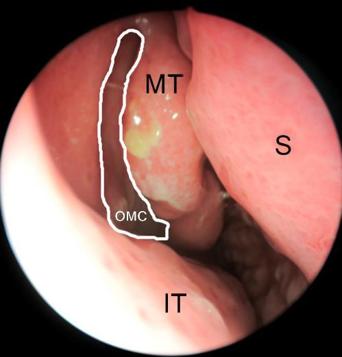 sinus sphenoidalis OMC Ostio-Meatalis Complex Ez egy fontos anatomiai és funkcionális egysége az orrnak, mely terminus technicus alatt a középső orrjáratot és az ide nyíló járatokat értjük (Ábra 2.8.