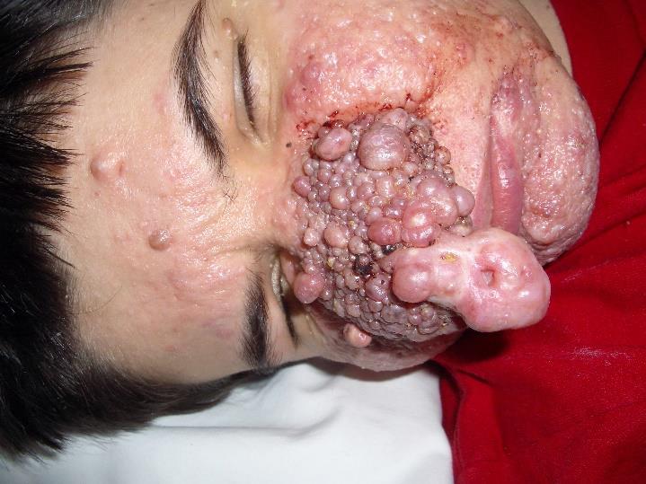 - sclerosis