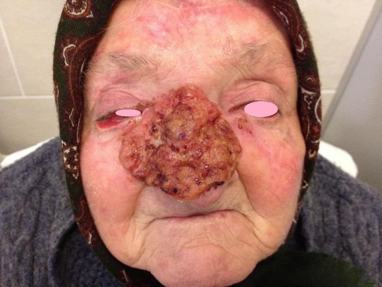 ) - Rhinophyma
