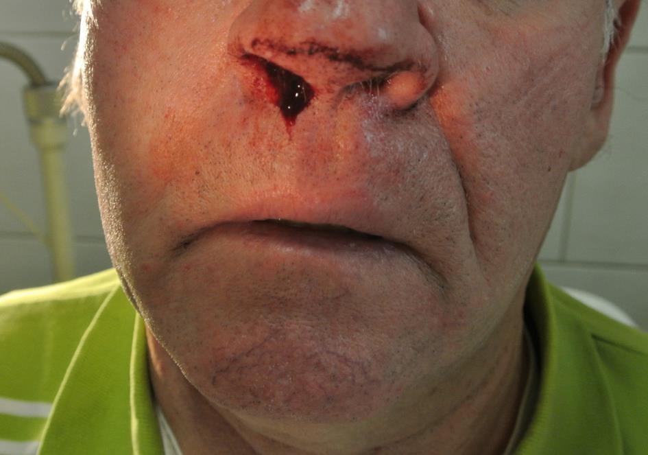 Epistaxis (Ábra 2.21.