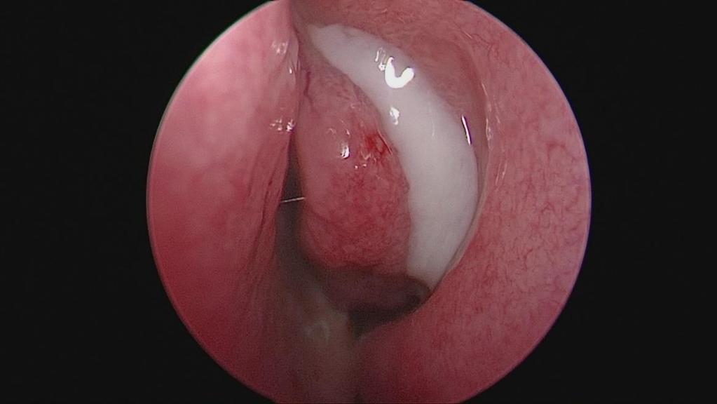 serosus, purulens) (Ábra
