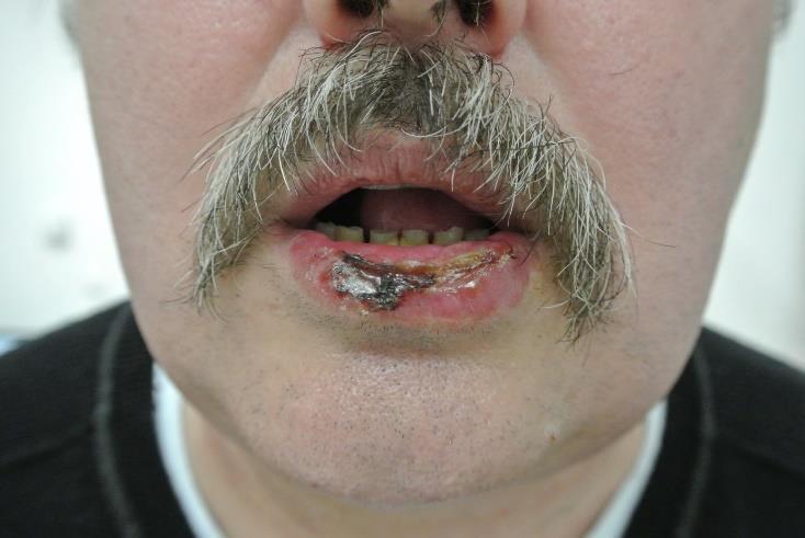 Gyulladások cheilitis (Ábra 3.5.