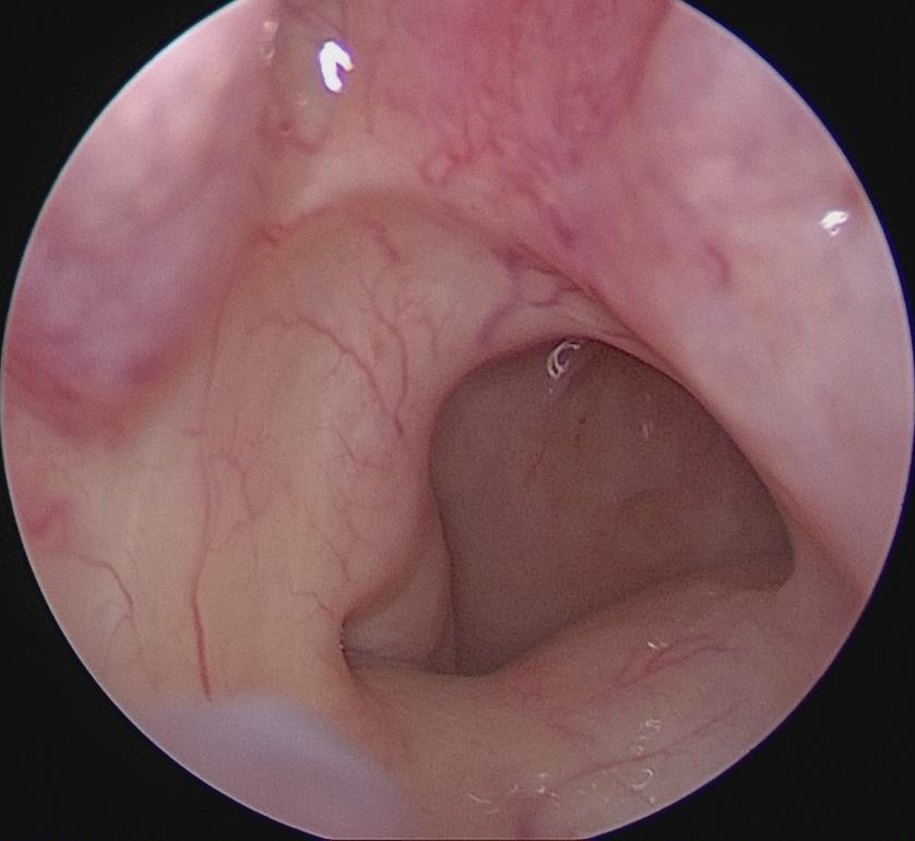 Merev orrendoscopos orrgarat vizsgálat 0 0 vagy 30 0 merev endoscoppal vizsgáljuk a beteget topicalis érzéstelenítésben vagy anélkül.