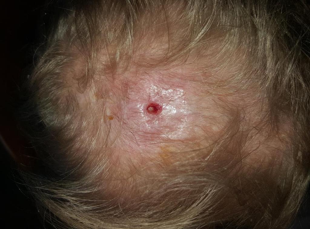 Epiduralis empyema, osteomyelitis Általános tünetek: Fejfájás Láz