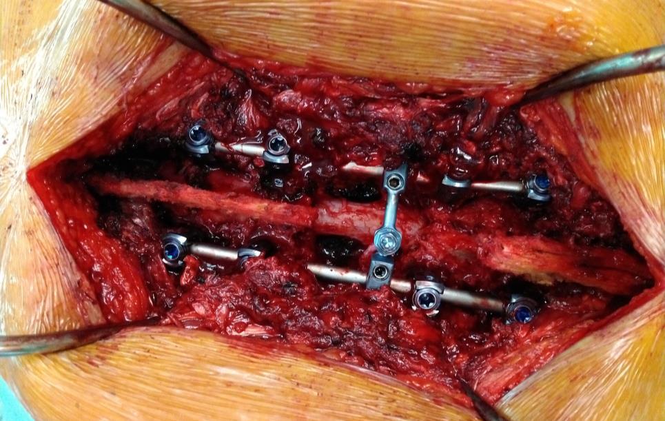 Csigolyatest pótlás Mesh, lift-cage, csontgraft