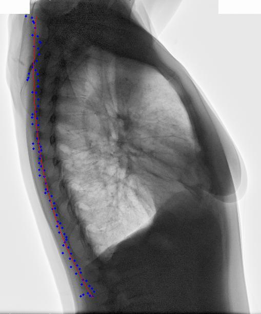 A következő ábra pedig egy másik röntgenfelvételt mutat, ahol a kontroll pontokat is feltűntettem: A tüdő körvonalától kissé balra tolódva találja meg a körvonalat az algoritmus egyelőre, mivel új