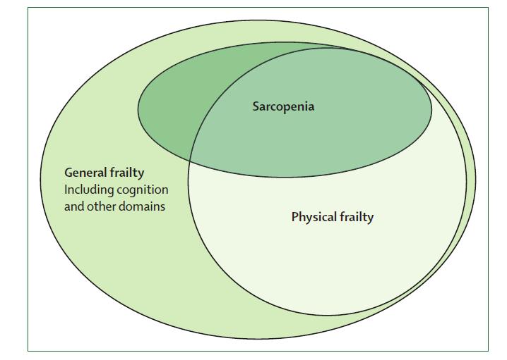 ábra Esendőség és sarcopenia: diagnosztikai átfedések [2] Baumgartner 2000-ben írta le az elhízásban előforduló sarcopeniát sarcopeniás obesitas néven [16]. (Az adipositas elrejtheti az izomvesztést!