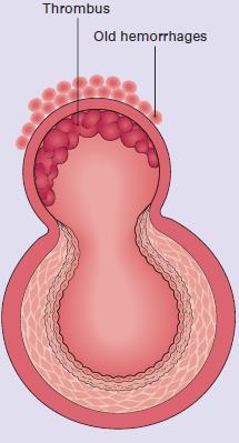 Intraparenchymalis arteriolák