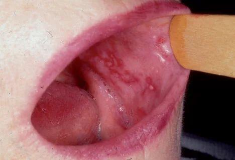 lichenoid mintázat -