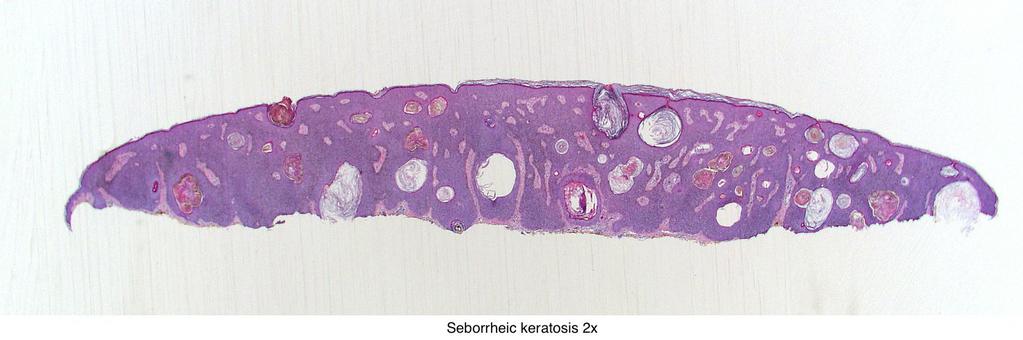 seborrhoeas
