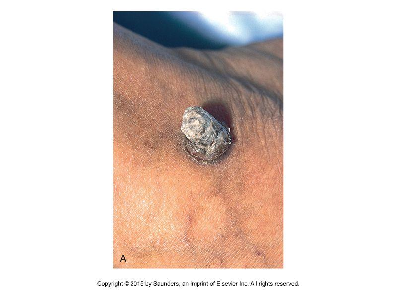 Epidermális