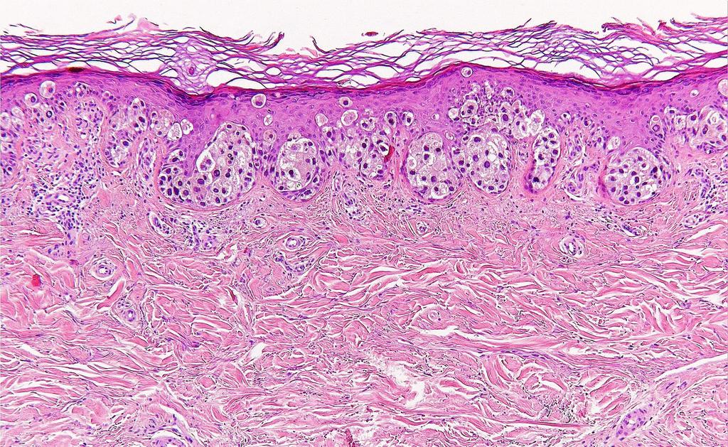 Melanocytás elváltozások - Melanoma Melanoma SSM