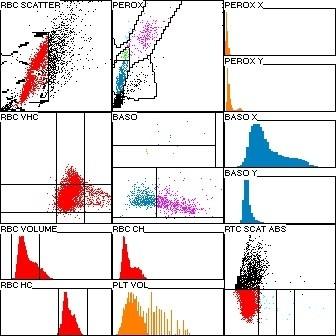 Hematológia Eredmény Referencia Vérkép (mennyiségi + minőségi + retikulocyta) Fehérvérsejtszám (WBC) 6,0 G/l 6,0-12,0 G/l Neutrophil granulocyta szám 0,5 G/l - 3,0-11,5 G/l Lymphocyta szám 5,1 G/l +