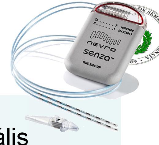 Célzott gerincvelő stimuláció (Targeted spinal cord stimulation) Cervico-medulláris junkció (SCS-CMJ) Kezelhetetlen fej és arcfájdalom (glosszofaringeális fájdalom) Tomycz ND et al Cervicomedullary