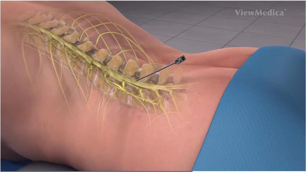 Célzott gerincvelő stimuláció (Targeted spinal cord stimulation) Klasszikusan a hátsó traktus érzésteleníté Shealy CN, et al Anesth Analg. 1967 Jul-Aug;46(4):489-91.