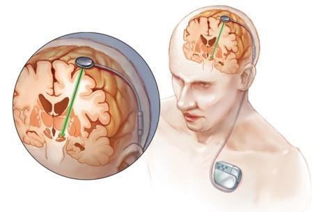 Deep-brain stimuláció J