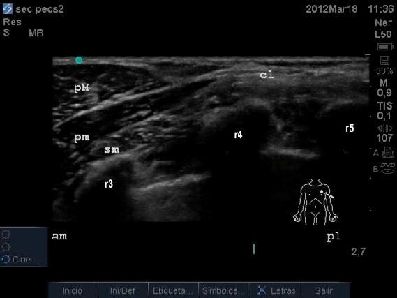 transversus abdominis plane