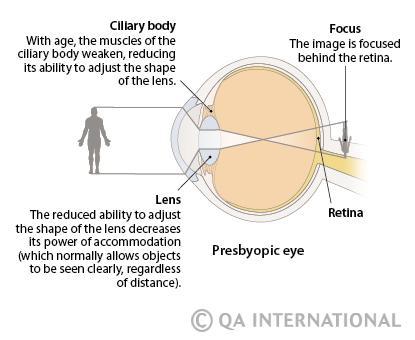 Öregkori távollátás (presbyopia): A közelpont távolsága az életkor előrehaladtával nő. Ezt főleg a lencse merevségének fokozódása okozza, ui.