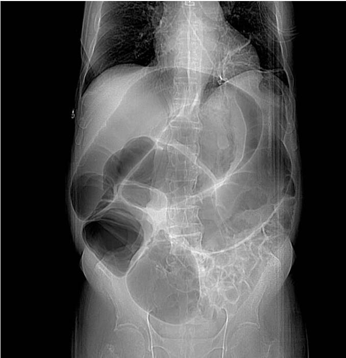 Egyes kemoterápiás szerek mellékhatásai taxánok: mucositis, hasmenés methotrexate: hepatotoxicitás capecitabin: