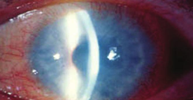 Herpesz eredetű keratitisek klinikai megjelenési formái és kezelése 4. ábra: Interstitialis keratitis 5. ábra: ntigén-antitest-komplement-kaszkád okozta interstitialis keratitis 3.