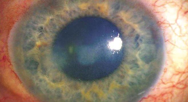z uveitis kialakulása az uveális szövetben és a trabekuláris rendszerben szaporodó litikus vírusokkal szembeni immunreakció következtében alakul ki.