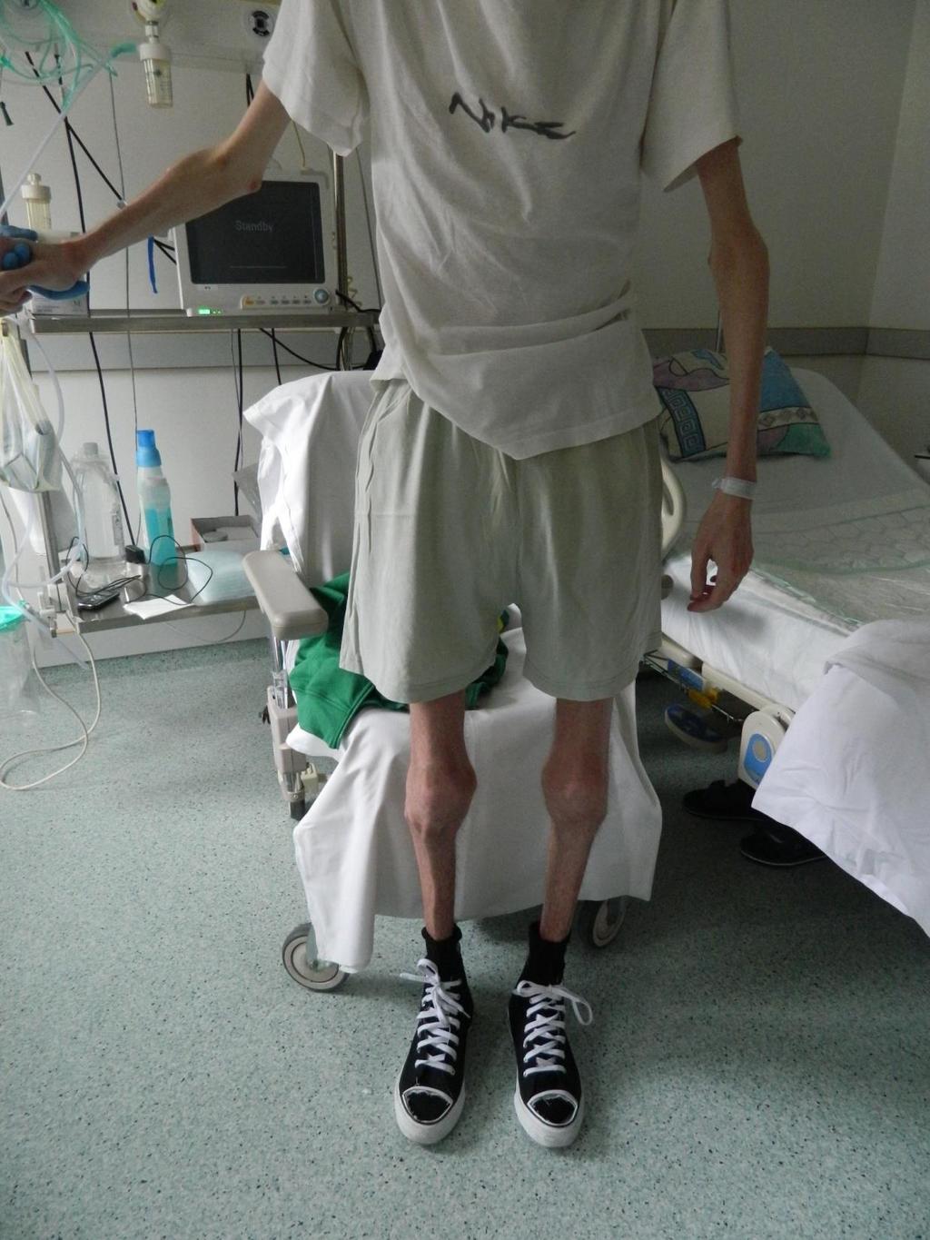 miatt leállítása 2013- adalimumab kezelés 2014- elején súlyos malnutrició +
