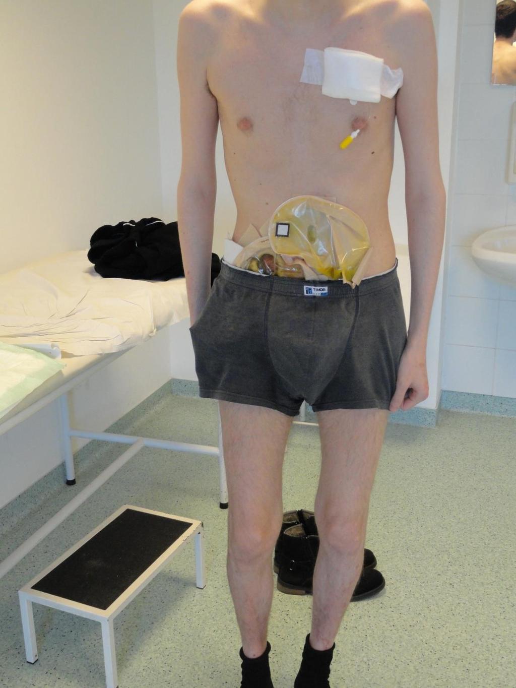 tól ismét adalimumab kezelés Időközben többszörös műtétek során I. tip.