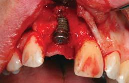 táblázatban pedig az ITI (International Team of Implantology, Nemzetközi Implantológiai Társaság) szerinti esztétikai rizikófelmérés eredménye látható.