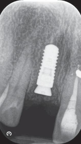 Az autogén csontforgáccsal beborítottuk az implantátum szabadon maradt felszínét (9. ábra).