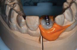ábra). Az optimális esztétikai hatás és a megfelelő emer gencia profil kialakítása céljából a Straumann ideiglenes implantátumfejet dentin és zománc árnyalatú kompozittal építettük fel.