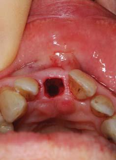 A cikk célja az SST alkalmazásának bemutatása a maxilla anterior régiójában annak érdekében, hogy konzervatív módon megőrizzék a szöveti architektúrát és optimális esztétikai eredményt érjenek el.
