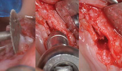 Az implantátumok túlélési aránya (Implant Survival Rate = ISR) 92% és 100% között mutatkozik, függetlenül az elhorgonyzási elem típusától és a páciens életkorától.