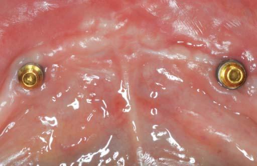 fogpótlást. Az alsó protézist két, interforaminalis területre behelyezett implantátummal stabilizáljuk (6. ábra).