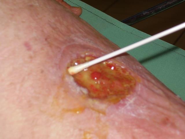 4. Infekció ellátás Sebváladék- mikrobiologiai vizsgálathoz mintavétel Baktérium leoltás a seb bő vizes lemosása /mechanikus tisztítás a mély sebrészekből, alávájt szélekből a gyulladásos terület és