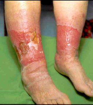 lymphangitis