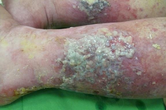 letörölhető Biofilm -