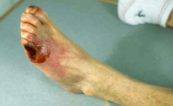 Lymphangitis A fertőzött seb progresszióját jelenti a nyirokér gyulladás.