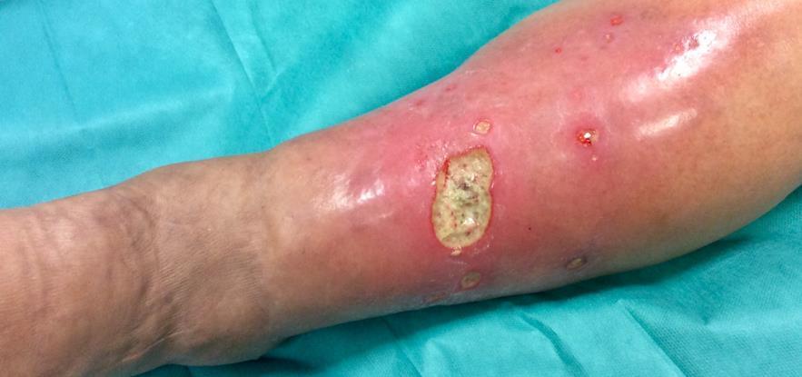 Cellulitis A cellulitis akut bakteriális fertőzés a kötőszövet mélyebb rétegeiben, sürgős, szakszerű ellátást igényel.
