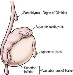 Appendix testis és appendix epididymis A Sertoli sejtek által termelt anti-müller hormon hatására a ductus paramesonephricus (Müller-cső) degenerálódik kivéve egy kis részt, ami a here craniális