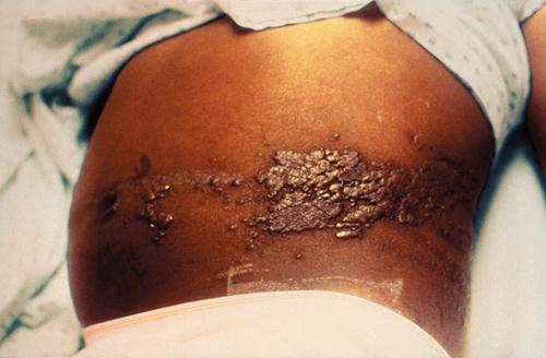 fájdalmas bőrelváltozások egy-egy dermatomban alakulnak ki és egyoldaliak, nem lépik át a test középvonalát (3.2.3. ábra). A bőrelváltozásokból fertőző vírus ürül a környezetbe. 3.2.3. ábra. Herpes zooster, övsömör (CDC, PHIL, USA, No.