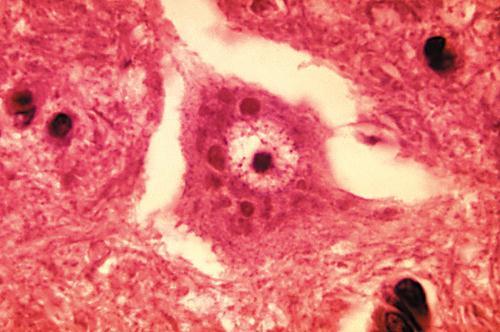gyökereihez és a gerincvelőbe. Mihelyt a vírus bekerül a gerincvelőbe az agy is hamarosan fertőződik (hippocampus, az agyvelő, az agyalapi magvak ganglion sejtjei és a kisagy Purkinje-sejtjei).